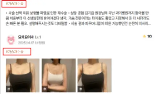 모티바재수술, 진행한 109명을 대상으로 3년간 관찰한 연구결과를 보여드립니다. — 본문 이미지 7