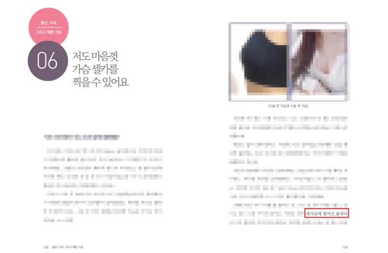 새가슴교정, 가슴 수술하면 옆으로 벌어지진 않을까?<20년 가슴성형만 연구한 병원 답변> — 본문 이미지 20