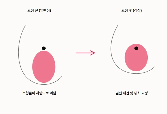 가슴재수술시기, 밑빠짐으로 재수술 고민이라면 필독 <20년간 가슴성형만을 연구한 의료진 작성> — 본문 이미지 6