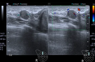 가슴보형물파열증상 의심된다면, MRI vs 초음파 어떤 검사를 받아야 할까?<20년 가슴성형만 연구한 곳 작성> — 본문 이미지 5
