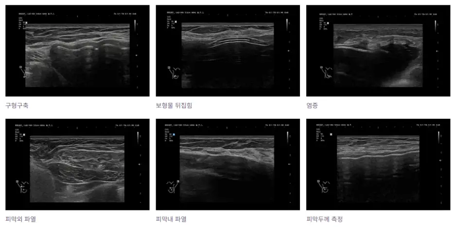 가슴수술후관리, 타지에서 받아도 되나? 자주 가야 되는 건 아닐까 — 본문 이미지 6