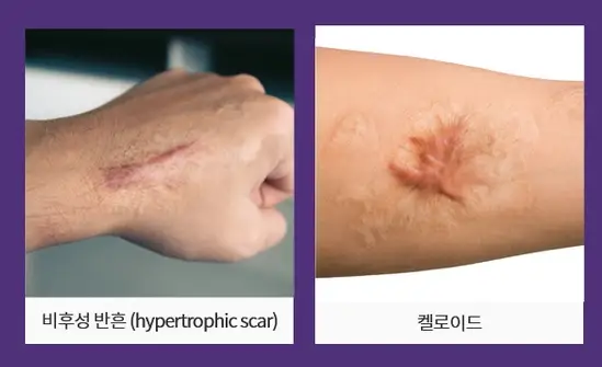 가슴성형흉터? 겨절/밑절 형태와 경과까지 총 정리해 드립니다. — 본문 이미지 5
