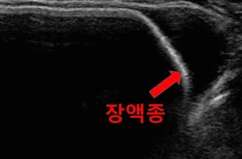 가슴수술회복기간, N일 평균만 믿고 연차내면 안되는 2가지 이유<20년간 가슴성형만 연구한 의료진 조언> — 본문 이미지 4