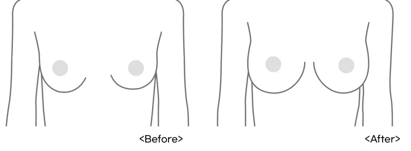 작은가슴, 75AA도 C컵 가능할까? 후기로 보형물 크기 정하는 분께 드리는 조언 — 본문 이미지 4