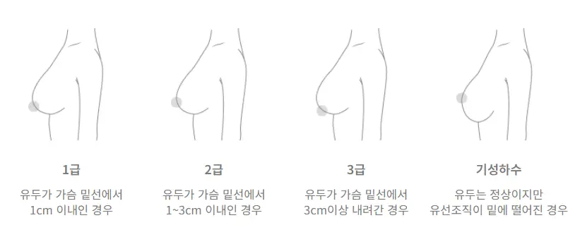 출산후가슴처짐, 윗 가슴만 보형물로 채우면 될 거라는 착각? — 본문 이미지 6