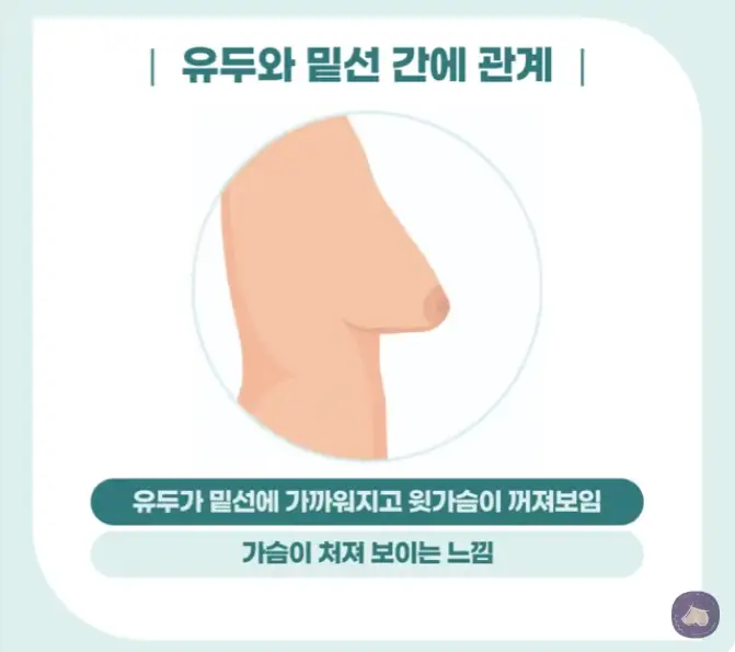 처진가슴수술비용? 후기에도 속지 마세요. — 본문 이미지 4
