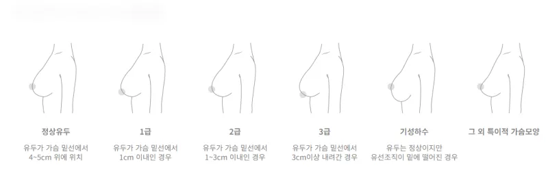 레그노 분류법을 기준으로 보는 가슴처짐 정도