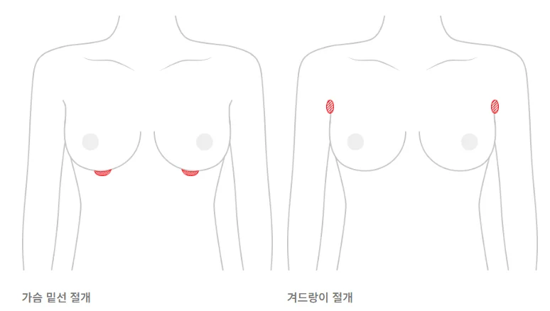 가슴수술흉터관리,몇 개월까지 해야할까?<20년 가슴성형을 연구한 의료진 답변> — 본문 이미지 4