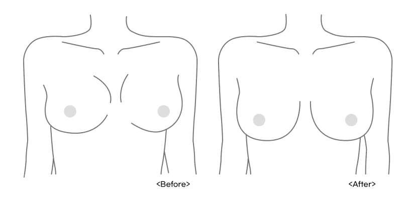 가슴보형물파열, 제거 전 가장 많이 받는 질문 5가지 <20년 가슴성형 연구 병원 작성> — 본문 이미지 16
