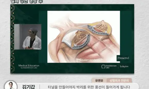 가슴성형흉터? 0.5~1cm 줄일 방법을 공개합니다. <작년 3023건 보형물 수술한 곳에서 드리는 조언> — 본문 이미지 8