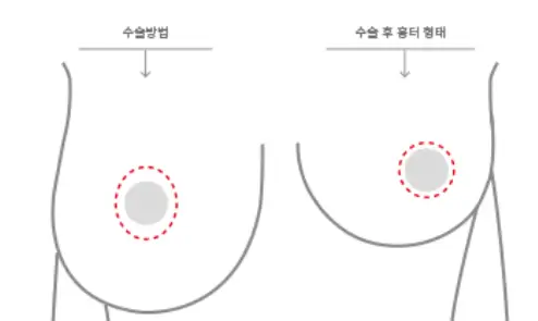 처진가슴수술비용, 거상술 / 보형물이 필요한 경우도 정리해드리겠습니다. <20년의 연구경험으로 드리는 조언> — 본문 이미지 6