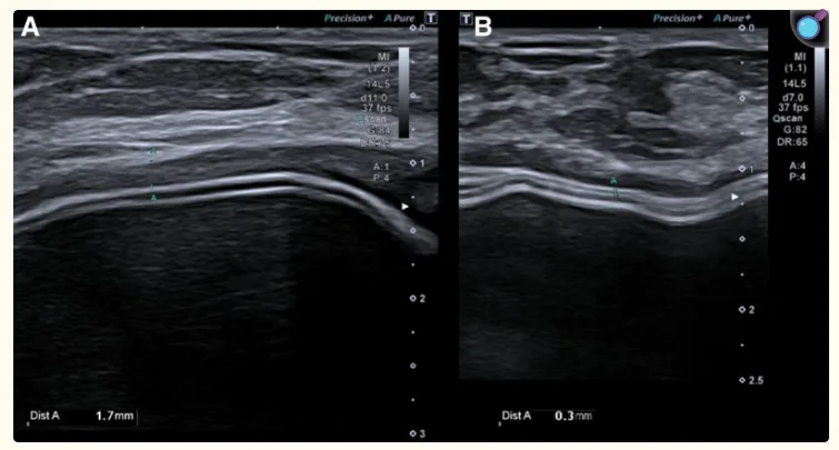 이미지 출처 : Torres-Zuñiga et al., PRS Global Open (2022), “Ultrasound Criteria and Baker Scale for Breast Implant Capsular Contracture Diagnosis.”