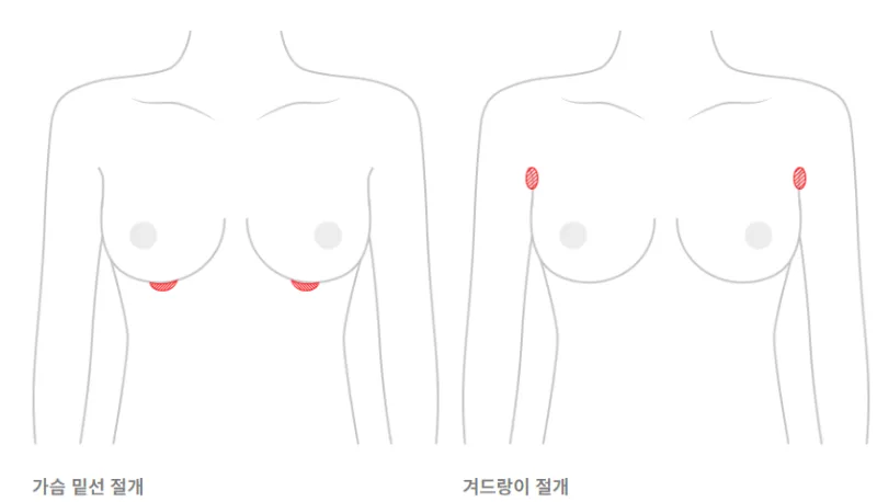 가슴재수술병원, 대형 병원 가면 해결될까?<20년 연구 경험으로 드리는 조언> — 본문 이미지 6