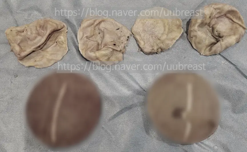 가슴성형촉감, 수술 이후 언제 말랑해질까? <20년의 연구 경험> — 본문 이미지 9