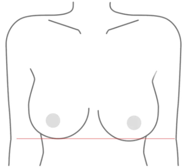 가슴성형외과 추천, 짝가슴 교정은 더 어려운 걸까? <작년 3404건 보형물 이식한 병원 작성> — 본문 이미지 7