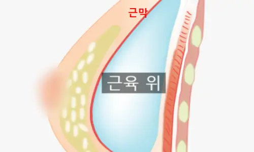 유방확대술비용? 1가지가 수십 수백만원을 결정합니다. <20년의 연구 경험으로 드리는 조언> — 본문 이미지 14
