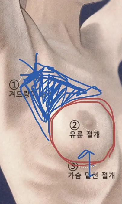 가슴수술종류, 겨드랑이/밑선 절개? 장단점에 대하여 (20년 연구 경험) — 본문 이미지 7