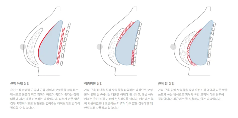 가슴확대수술후기 100개를 봐도 혼란스럽다면? <20년 가슴성형 전문의 조언> — 본문 이미지 7