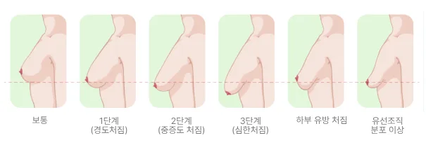 처진가슴수술비용, 가슴크림·보정속옷 후기에 속지 마세요 <20년간 가슴만 연구한 의료진 작성> — 본문 이미지 5