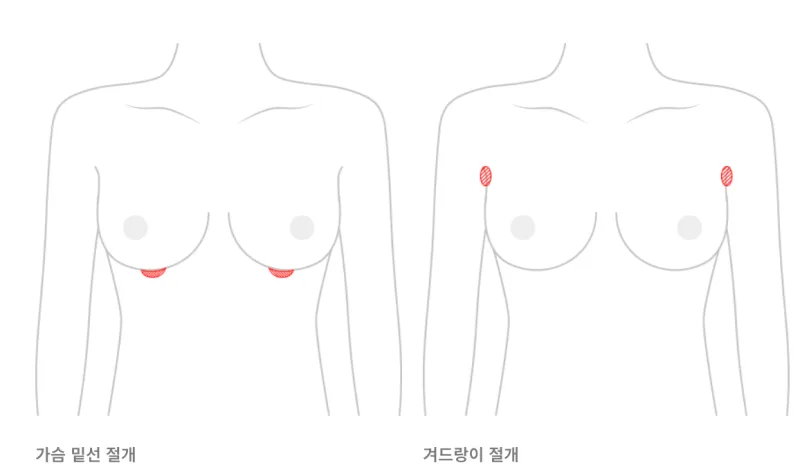 가슴보형물파열, 제거 전 가장 많이 받는 질문 5가지 <20년 가슴성형 연구 병원 작성> — 본문 이미지 13