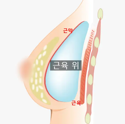 근막하, 이중평면 비교? 이 글 하나에 모두 정리해두었습니다. — 본문 이미지 3