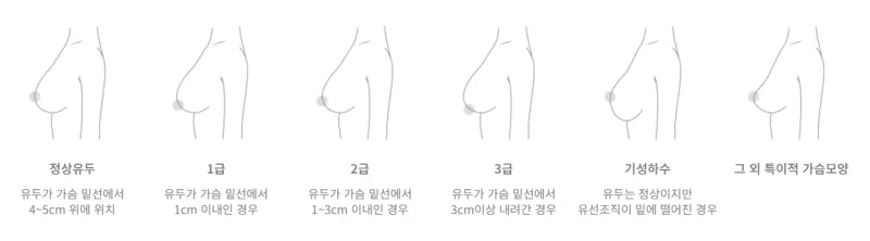 가슴거상수술