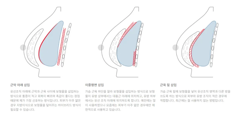 가슴확대수술비용, 병원마다 차이 나는 이유?<보형물 3,023건 수술한 병원에서 알려드립니다> — 본문 이미지 6