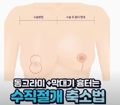 가슴축소술, 사이즈별 절개 방법까지 20년의 연구 경험으로 알려드립니다. — 본문 이미지 5