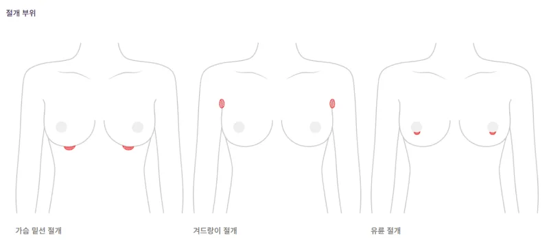 서울가슴수술 상담만 6번? 3,404건 보형물 이식한 데이터로 본 병원 선택기준 — 본문 이미지 6
