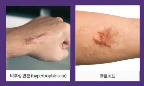 가슴성형흉터? 0.5~1cm 줄일 방법을 공개합니다. <작년 3023건 보형물 수술한 곳에서 드리는 조언> — 본문 이미지 4