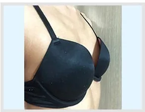 가슴성형 전 측면 사진 3