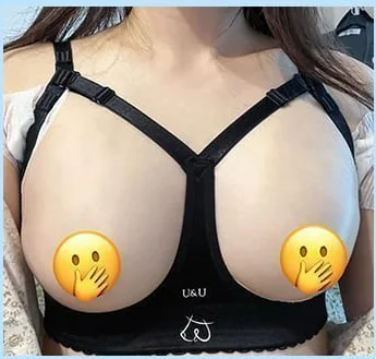 가슴성형 2일차 보정브라 착용 정면 사진 1