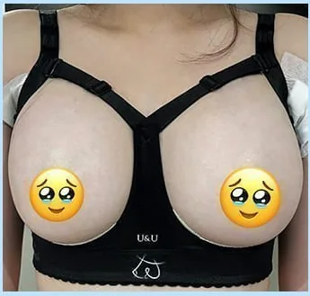 가슴성형 2일차 보정브라 착용 정면 사진 2