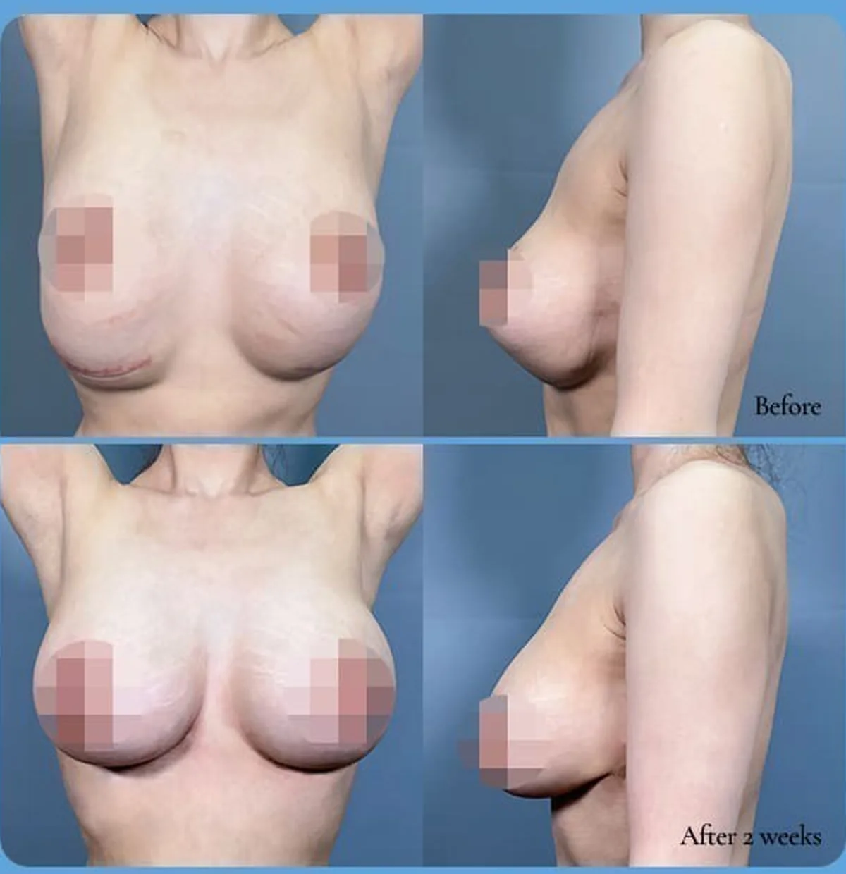 밑빠짐 재수술 전후 비교 사진 — Before / After 2 weeks (정면·측면)