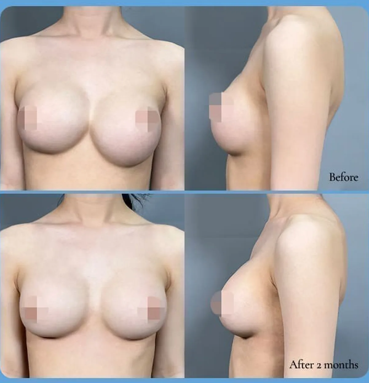 앞빠짐(합체증)·밑빠짐 재수술 전후 비교 사진 — Before / After 2 months (정면·측면)