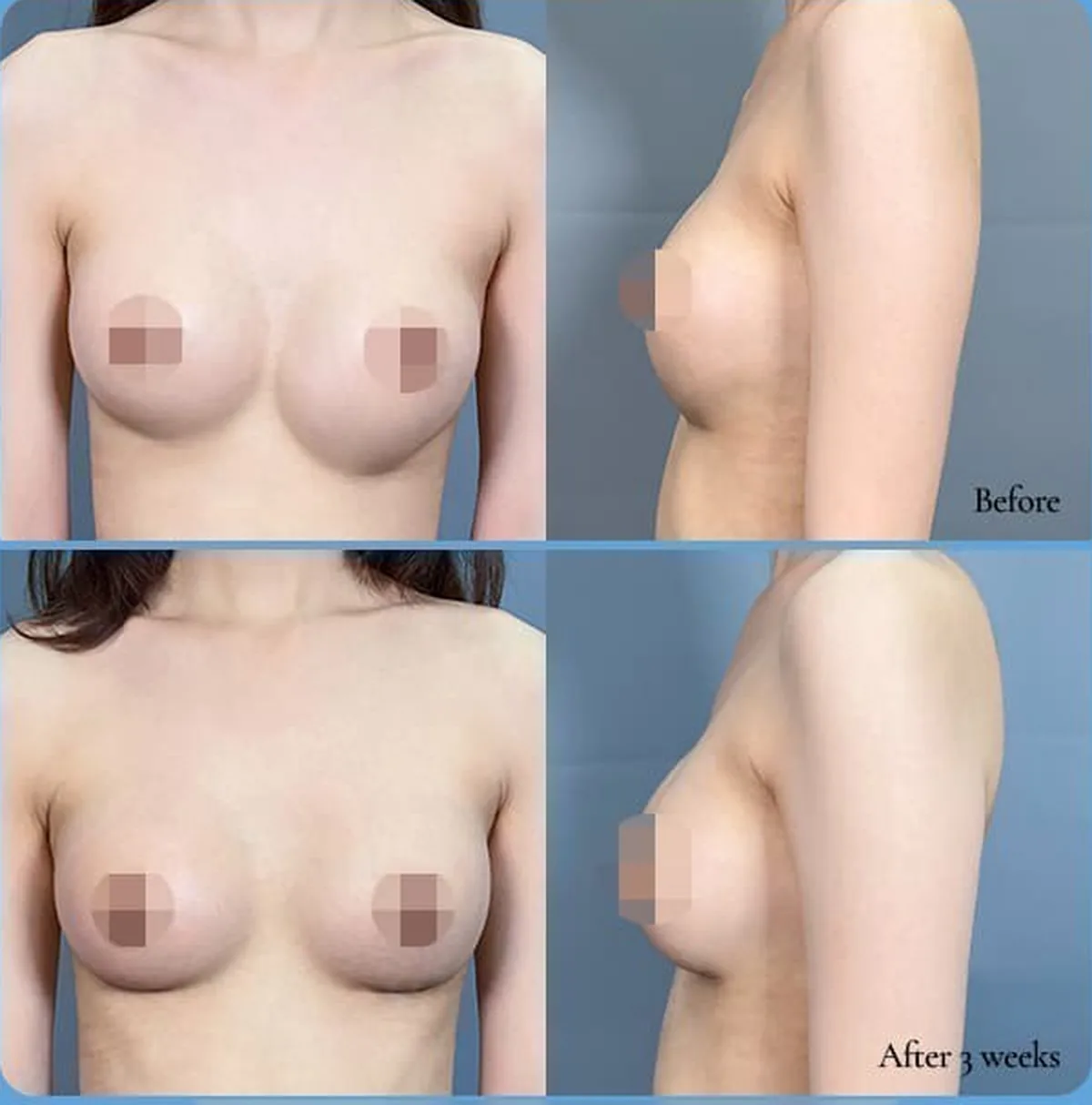 밑빠짐 비대칭 재수술 전후 비교 사진 — Before / After 3 weeks (정면·측면)