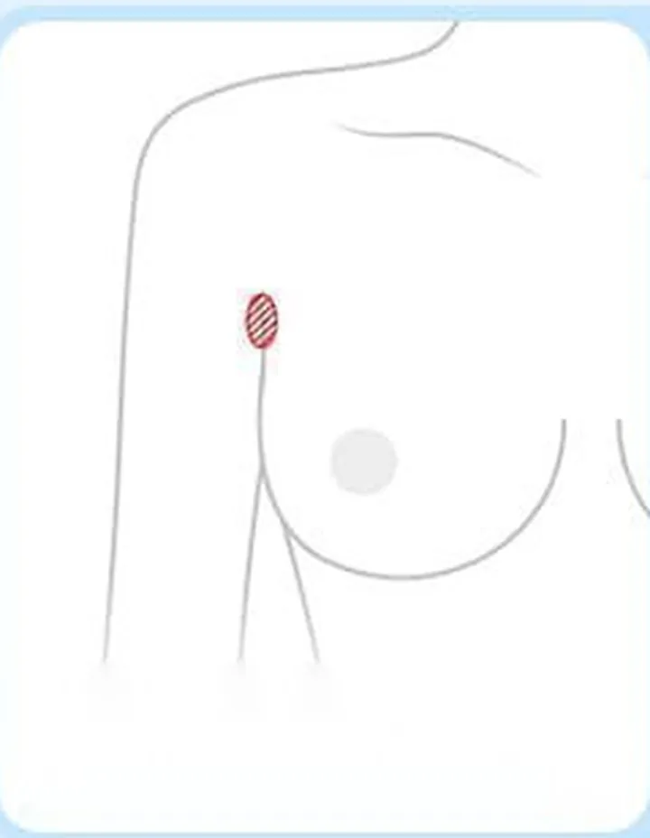 겨드랑이 절개 위치를 표시한 도해