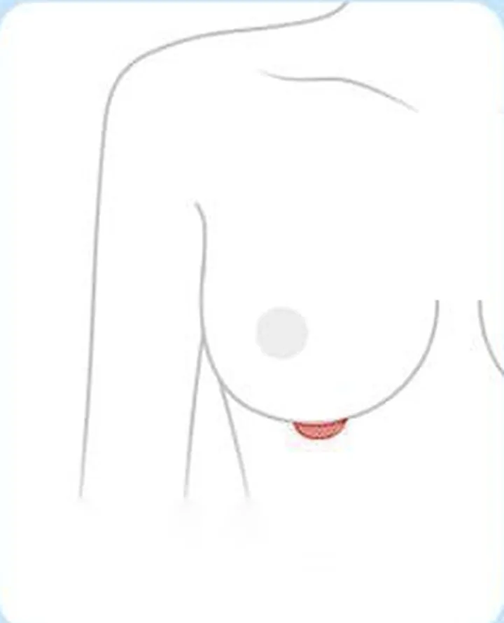 가슴 밑선 절개 위치를 표시한 도해