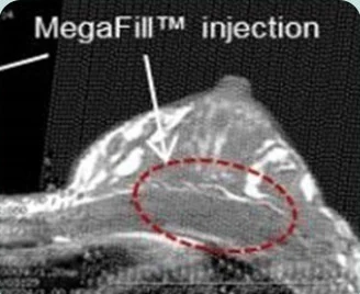 MegaFill™ injection — 가슴 측면 CT 영상에서 이식 부위를 표시한 이미지