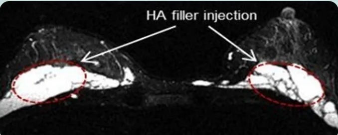HA filler injection — 양쪽 가슴 MRI 축상면 영상에서 필러 주입 부위를 표시한 이미지