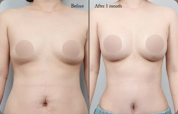 가슴복부 동시거상 수술 전과 수술 1개월 후 정면 비교 사진 1