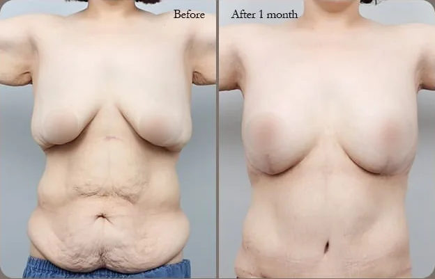 가슴복부 동시거상 수술 전과 수술 1개월 후 정면 비교 사진 4