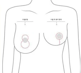 수직절개 위치와 수술 후 흉터 형태를 표시한 상반신 도해