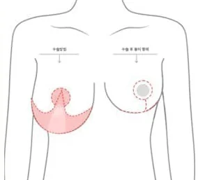 오자(ㅗ자)절개 범위와 수술 후 흉터 형태를 표시한 상반신 도해