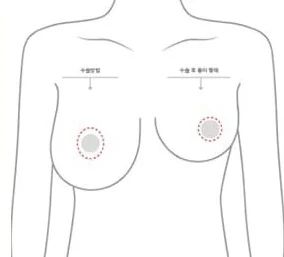 유륜절개 위치와 수술 후 흉터 형태를 표시한 상반신 도해
