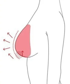 보형물 삽입과 함께 유두 위치를 올리는 가슴거상 측면 도해
