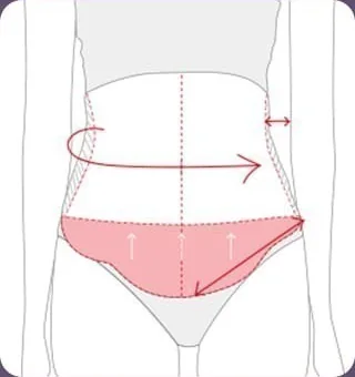 복부 수술 부위 디자인과 지방흡입 범위를 표시한 도해