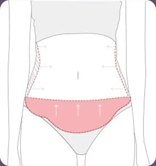 복부 전체 지방흡입 시행 범위를 표시한 도해