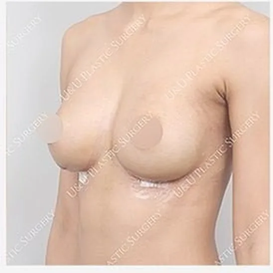 한쪽 가슴 재수술 후 측면 사진 3