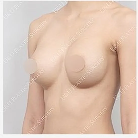 한쪽 가슴 재수술 전 측면 사진 3
